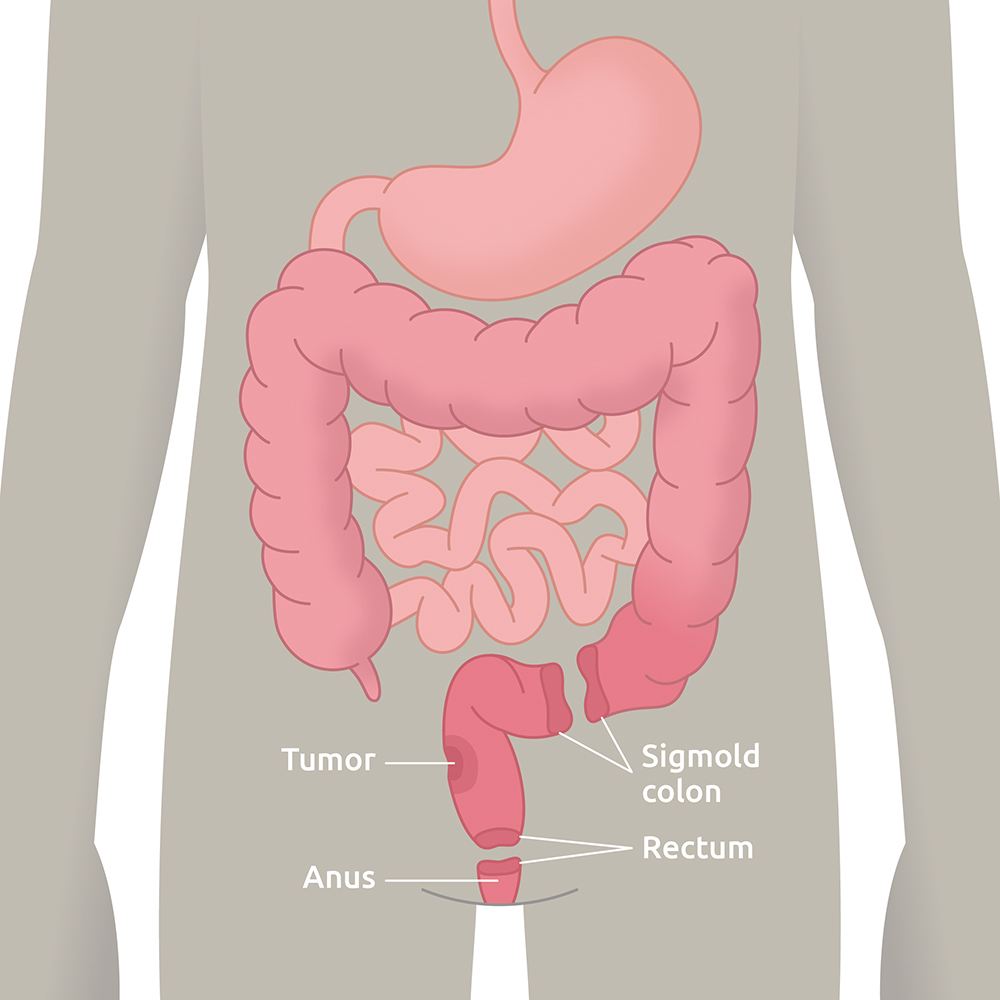 Lav Anterior Resektions Syndrom (LARS)​