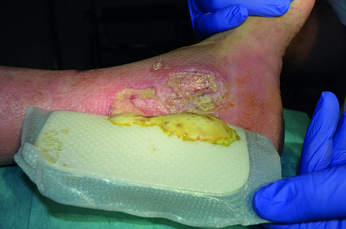 Hvad er en sølvbandage?