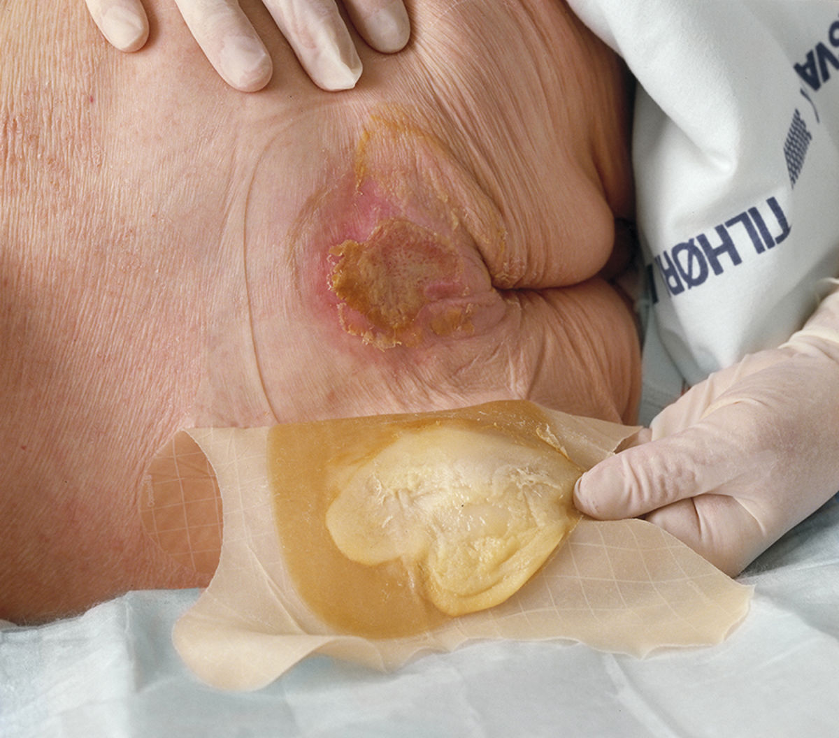 Her er nogle vigtige faktorer, du skal overveje, når du vælger en hydrokolloidbandage:
